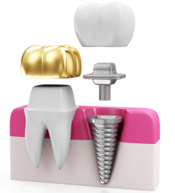Dental Jewellery
