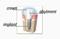 One Piece Implants and Flapless, Dental Implants In Delhi, Dental Implants In India