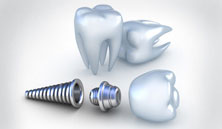 Minimal Surgical Implants, Dental Implants Clinic In Delhi, Dental Implants