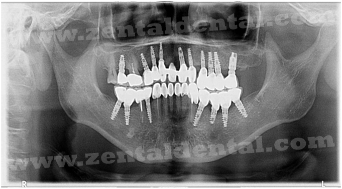 Implants with Caps on Abutments