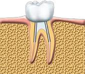 Root Canal Treatment In Delhi, Root Canal Treatment Cost In Delhi