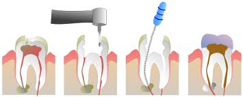 Root Canal Treatment, Root Canal Treatment In Delhi